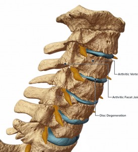 cervical spine degeneration